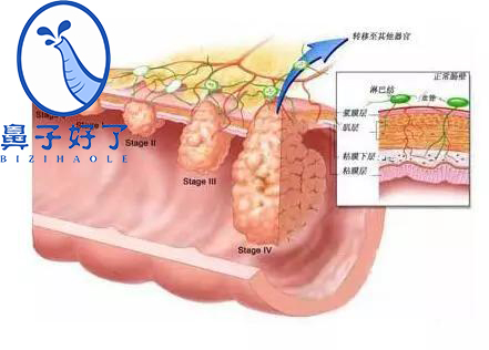 鼻炎馆加盟-警惕各种各样的息肉,小心是肿瘤性的病变!